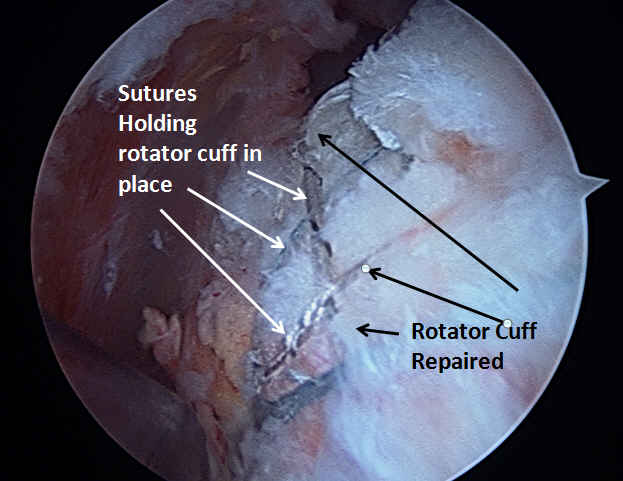 rotator cuff repair