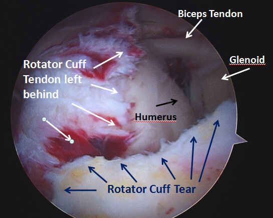 rotator cuff tear