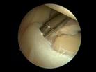 SLAP tear