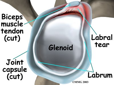 shoulder dislocation